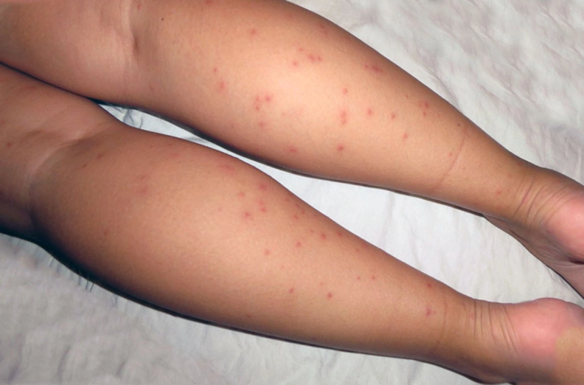 Фото с сайта dezinsektor.spb.ru