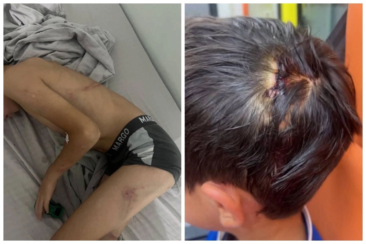 Гематомы на теле 8-летнего сына Мадины. Фото из соцсетей